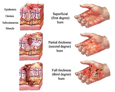 Classification of burn injuries